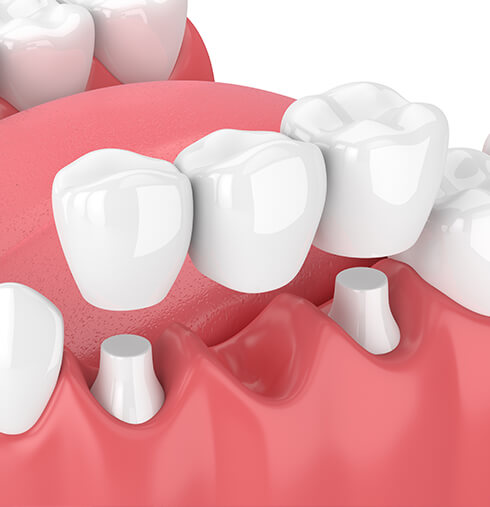 illustration of dental bridges