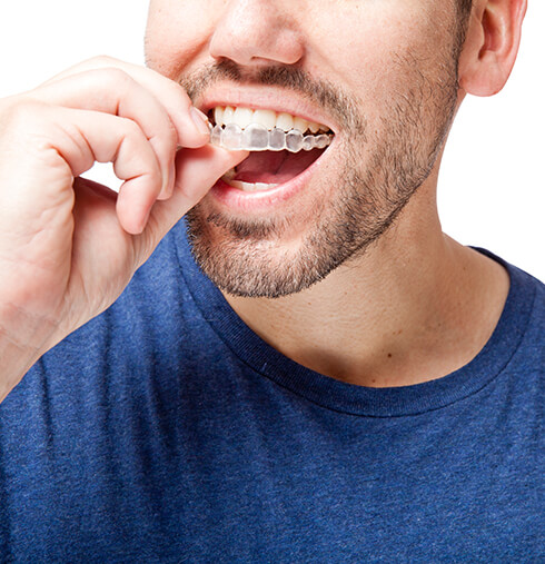 man putting clear aligners onto his teeth