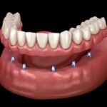 dentures, dental implants, missing teeth, tooth replacement, dental care, Austin dentist, Round Rock