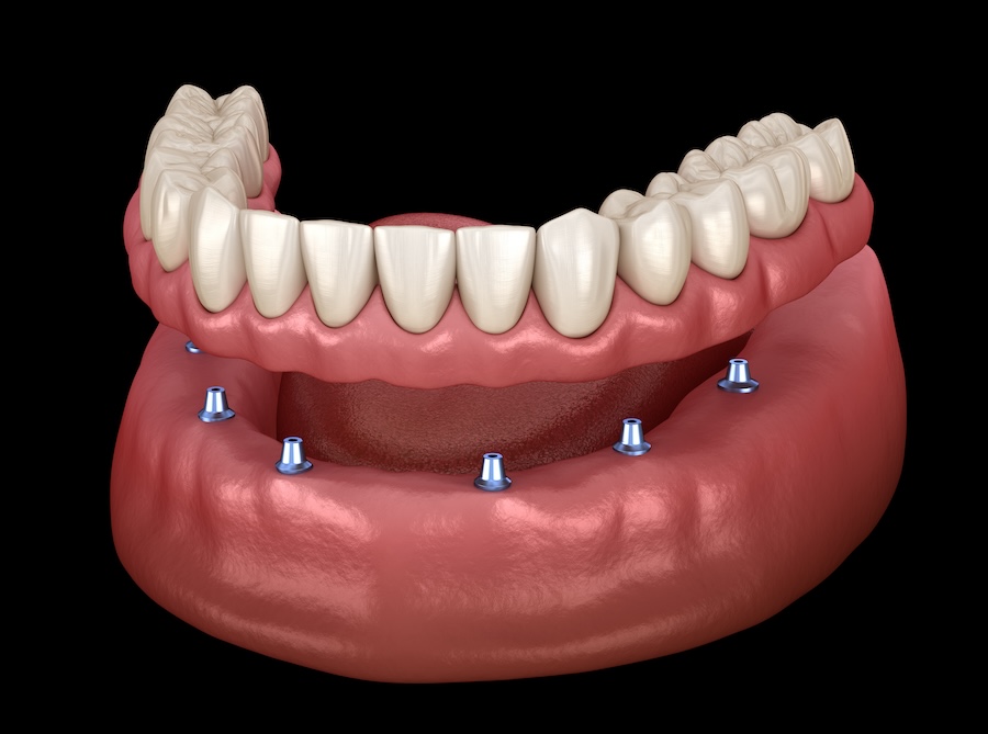 dentures, dental implants, missing teeth, tooth replacement, dental care, Austin dentist, Round Rock