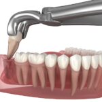 dental extraction aftercare, tooth extraction tips, post-extraction care, tooth removal recovery, dentist in East Austin, High Point Dentistry, avoid dry socket, tooth extraction healing, dentist in Round Rock, dentist in Austin, dentist South Congress