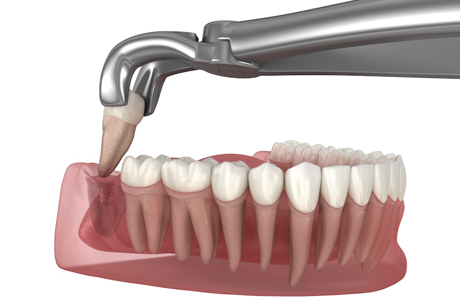 dental extraction aftercare, tooth extraction tips, post-extraction care, tooth removal recovery, dentist in East Austin, High Point Dentistry, avoid dry socket, tooth extraction healing, dentist in Round Rock, dentist in Austin, dentist South Congress